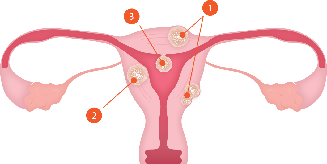 자궁근종 종류 이미지