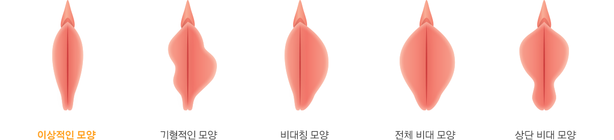 소음순 그림